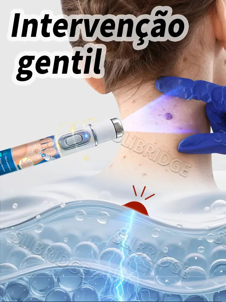 Caneta Não Invasiva Para Remoção De Verrugas