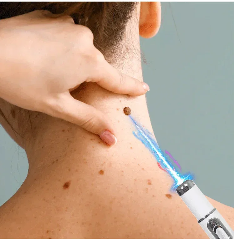 Caneta Não Invasiva Para Remoção De Verrugas
